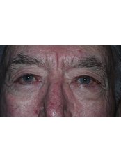 Eyelid surgery - Clearvision Medicare