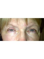 Eye Lift - Clearvision Medicare