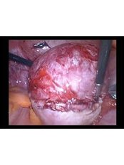 Laparoscopic Gynecological Surgery - Embryocosmos Michael Rotas MD Facog
