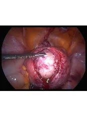 Myomectomy - Embryocosmos Michael Rotas MD Facog