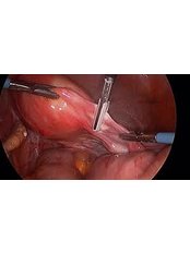 Laparoscopic Gynecological Surgery - Embryocosmos Michael Rotas MD Facog
