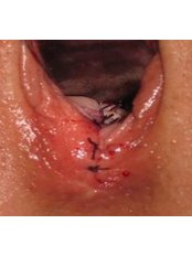 Vaginoplasty - Embryocosmos Michael Rotas MD Facog