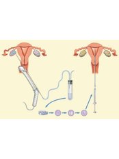 IVF - In Vitro Fertilisation - Select Surrogacy Clinic