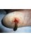 Bhopal Ayurvedic Surgical Center And Wound Clinic - tropical ulcer 