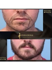 Beard Transplant - International Hair Clinic's