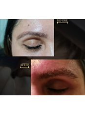 Eyebrow Transplant - International Hair Clinic's