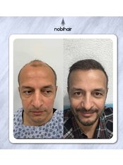 Hair Transplant - Nobi Hair Clinic