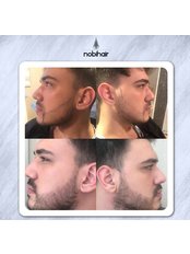 Beard Transplant - Nobi Hair Clinic