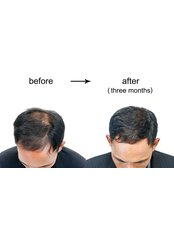 Hair Loss Treatment - Nobi Hair Clinic