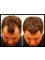 Australian Institute of Hair Restoration - Sydney - Before and After FUT Hair Transplant 