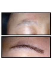 Eyebrow Transplant - Australian Institute of Hair Restoration - Sydney