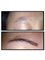 Australian Institute of Hair Restoration - Sydney - Before and After Eyebrow Transplant 