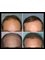 Australian Institute of Hair Restoration - Sydney - Before and After FUT Hair Transplant - AIHR 