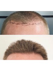 Hair Transplant - Martinick Hair Restoration Clinic - Sydney