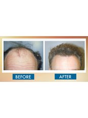 Hair Loss Specialist Consultation - Sydney Hair Transplant Clinic