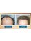 Sydney Hair Transplant Clinic - Before & After Hair Transplant (Patient #5) 