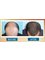 Sydney Hair Transplant Clinic - Before & After Hair Transplant (Patient #1) 