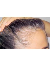 Hair Loss Treatment - Hair Health Australia