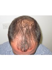 Treatment for Male Pattern Baldness - Hair Health Australia
