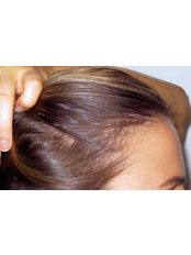 Hair Loss Treatment - Hair Health Australia