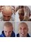 The Look SMP Clinic - Scalp Micropigmentation Melbourne & Sydney Before After 