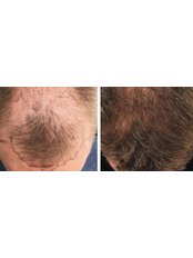 FUT - Follicular Unit Transplant - Martinick Hair Restoration Clinic - Perth