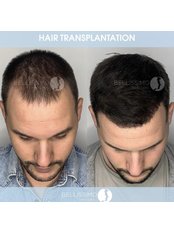 FUE - Follicular Unit Extraction - Bellissimo Hair Clinic