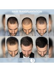 FUE - Follicular Unit Extraction - Bellissimo Hair Clinic