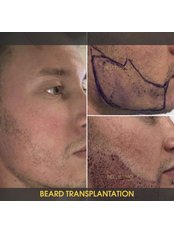 Beard Transplant - Bellissimo Hair Clinic