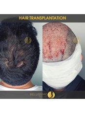 Bald Spot Removal - Bellissimo Hair Clinic