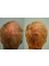 Reina Hair Transplant - Clinica Lungavita - Clinica Lungavita, Carrera 105 No. 15-20, Cali,  1