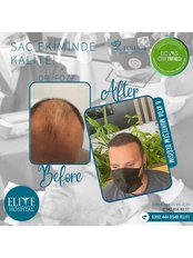 Hair Transplant - FUE Hub Cyprus - Hair Restoration