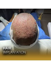 Hair Transplant - Confident Hair Clinic - Dominic Republic
