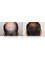 Clinic of Hair Transplant in Paris - Before and After a FUE Hair Transplant 