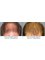 Clinic of Hair Transplant in Paris - Before and After a 1600 grafts FUE Hair Transplant 