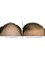 Clinic of Hair Transplant in Paris - Before and After a Artas FUE Hair Transplant 