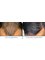Clinic of Hair Transplant in Paris - Before and After a Artas FUE Hair Transplant 