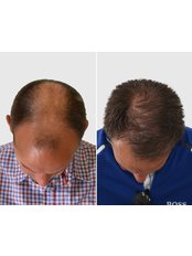 Treatment for Male Pattern Baldness - Seneca Hair Transplant - Athens