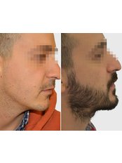Beard Transplant - Seneca Hair Transplant - Athens