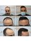 Anastasakis Hair Clinic - anastakis ahir clinic before-after results 