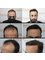 Anastasakis Hair Clinic - anastakis ahir clinic before-after results 