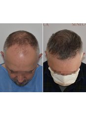 Treatment for Male Pattern Baldness - Seneca Hair Transplant - Thessaloniki