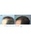 Schambach Medical Hair - Centro Clinico Capilar - Blvd. Vistahermosa 25-19 zone 15, Multimedica Level 11, suite 1103, Guatemala, Guatemala, 01015,  8