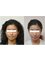 Hong Kong AttoHealth (Cosmetic) - Before and after effect 
