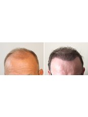 Greffe de cheveux - FUE 2 Safe System  - Garantie Écrite - HairPalace Clinique de Greffe de Cheveux France