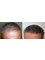 HairPalace Clinique de Greffe de Cheveux France - HairPalace 