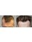 HairPalace Clinique de Greffe de Cheveux France - Hair transplant - before and after 