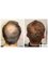 HairPalace Hair Transplant Clinic - Restore your crown at HairPalace 