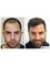 HairPalace Hair Transplant Clinic - Hairline correction result 
