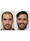 HairPalace Hair Transplant Clinic - Get back your dense hairline 
